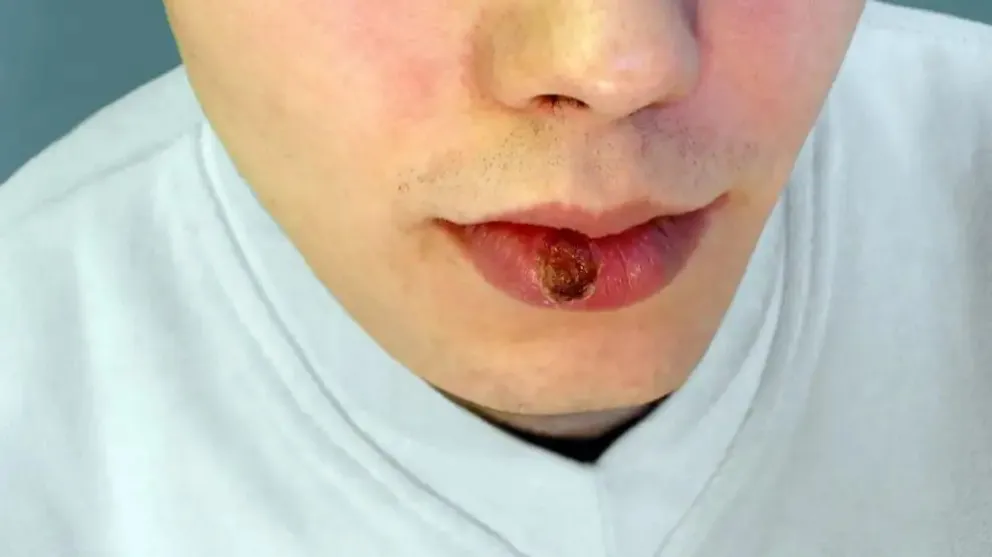 Los contagios de sífilis aumentaron más del 40% en Argentina. ¿Cuál es la situación en San Luis?